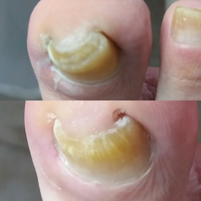 ošetření nehtů pomocí brusky